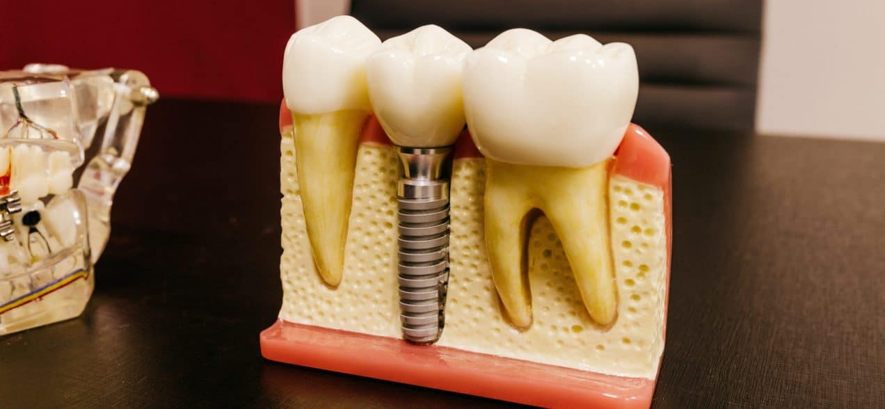 Dental Implants An Affordable Long Term Tooth Replacement Solution   Dental Implants An Affordable Image 