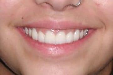 CARILLAS DE DIENTES POSTIZOS DE SONRISA – Loquequierasalamano