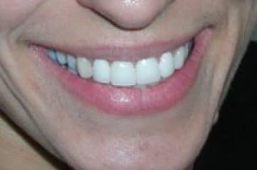 an image of a woman with piercing smiling after her procedure in big smile dental