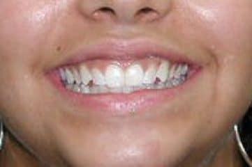 an image of a woman with mole smiling before her procedure in big smile dental