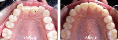 chicago clear braces before after