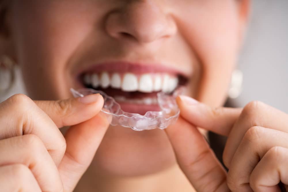 What are Invisalign Braces