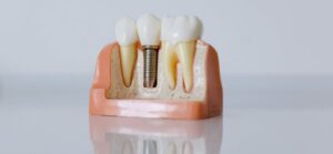 How to fix your missing teeth with dental implants