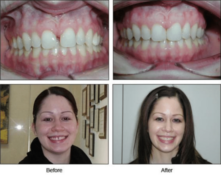 Invisalign Treatment in Chicago, IL | Big Smile Dental