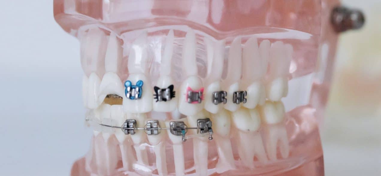 Comparing Treatment Capabilities: Invisalign and Traditional Metal Braces