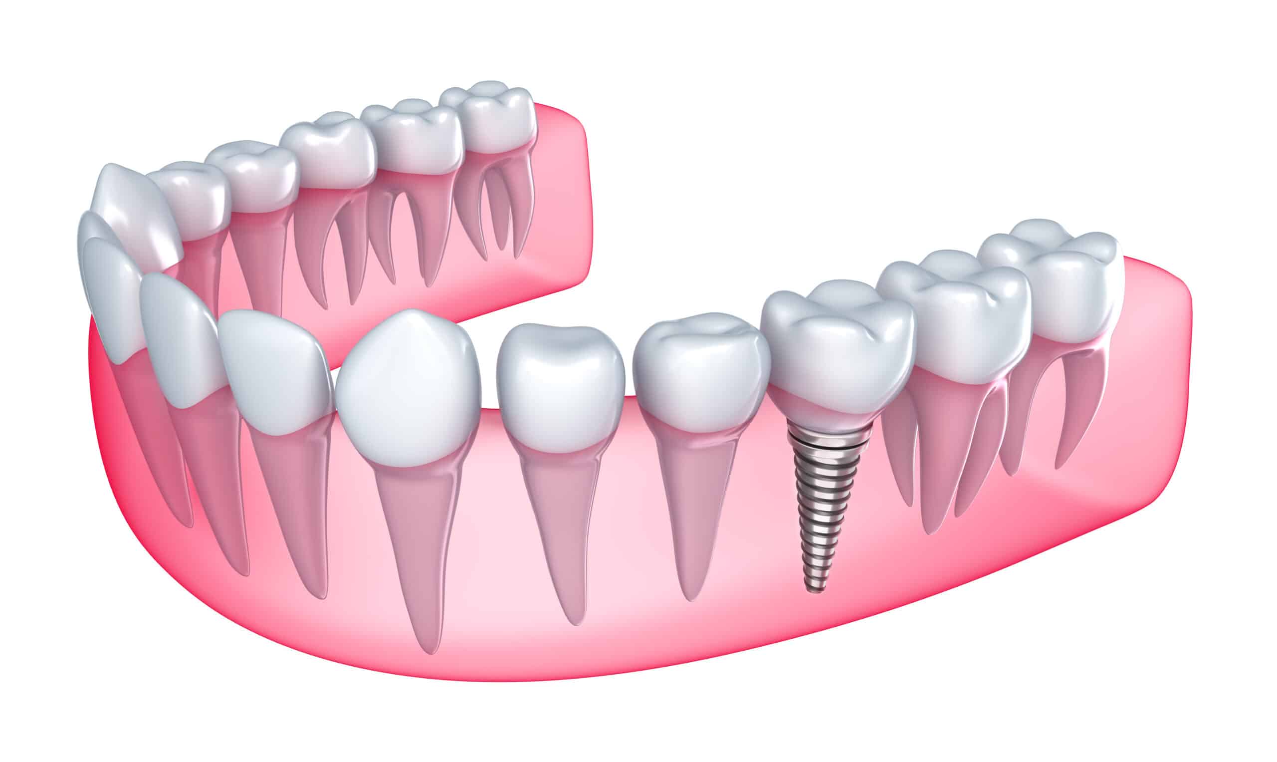 Teeth Implants