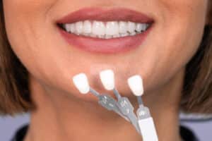 Dental Care Talk: Are Veneers Permanent??