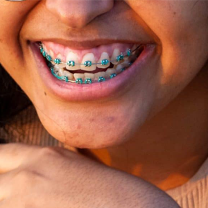 braces1