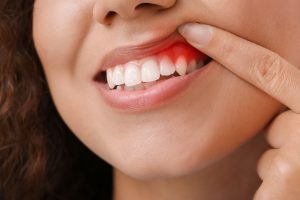 Your Gums May Have More on Their Mind Than You Think